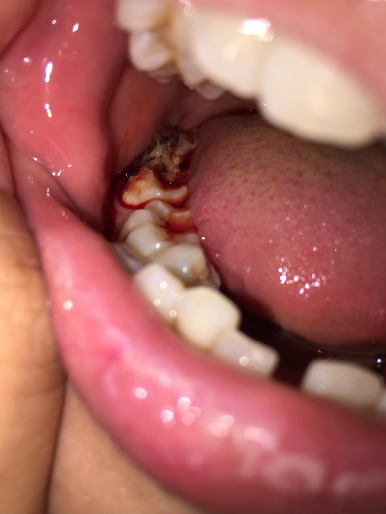 分享下自己拔智齿的经历