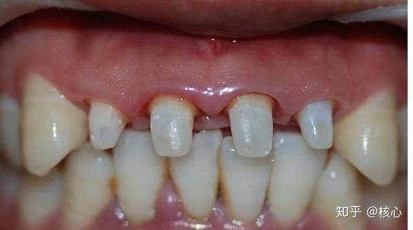 全冠就是把整个牙齿磨小,然后像戴帽子一样把牙齿整个盖住,优点是很