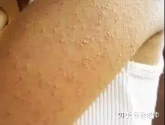 血毒到底是什么 知乎 血毒到底是什么 知乎
