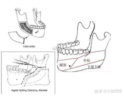 如何把控下颌角下缘和外板切除的关系