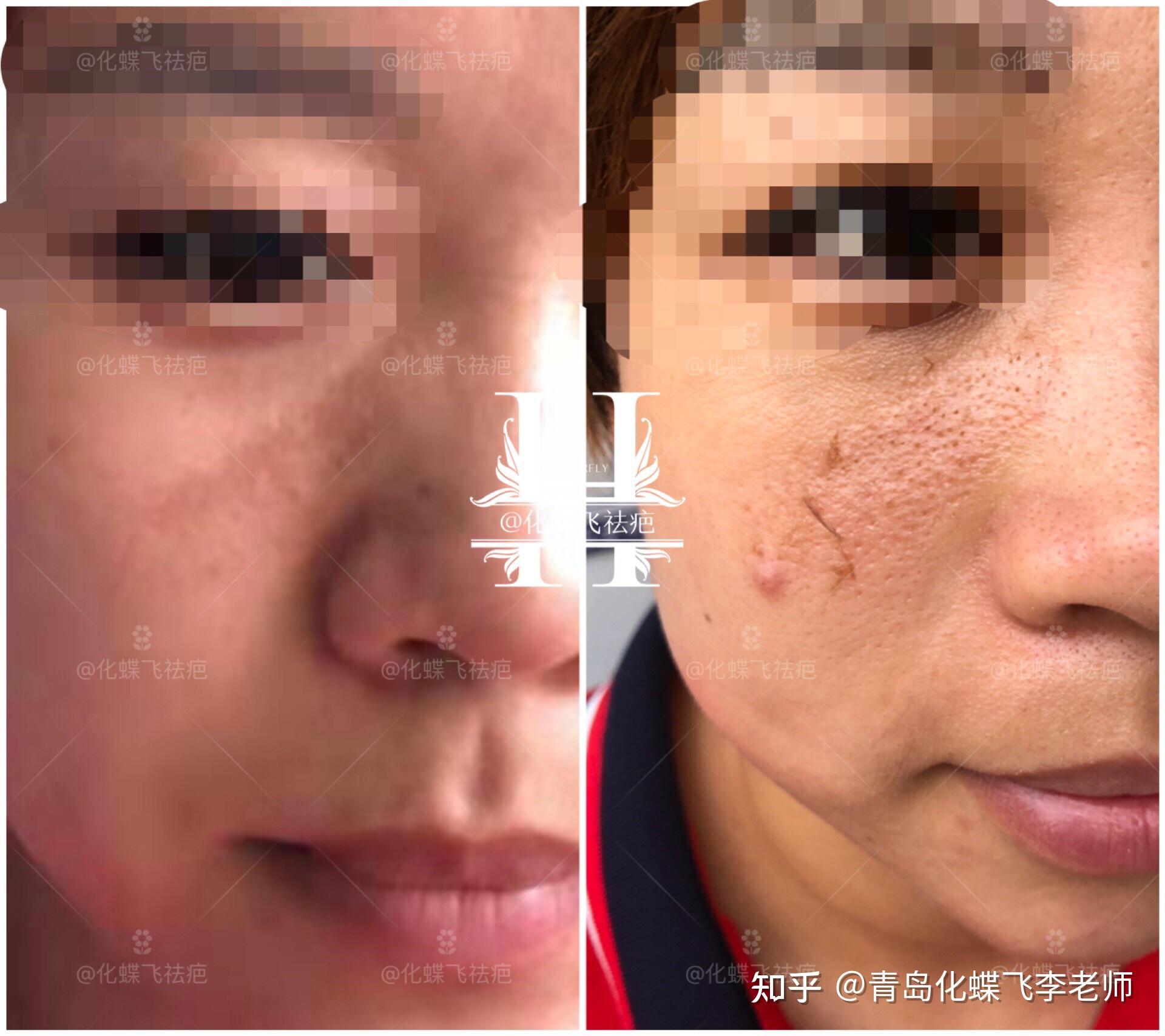 色素沉淀疤痕淡化效果 - 知乎