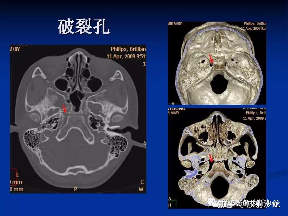 实用、详细的颅底各孔道影像解剖! - 知乎