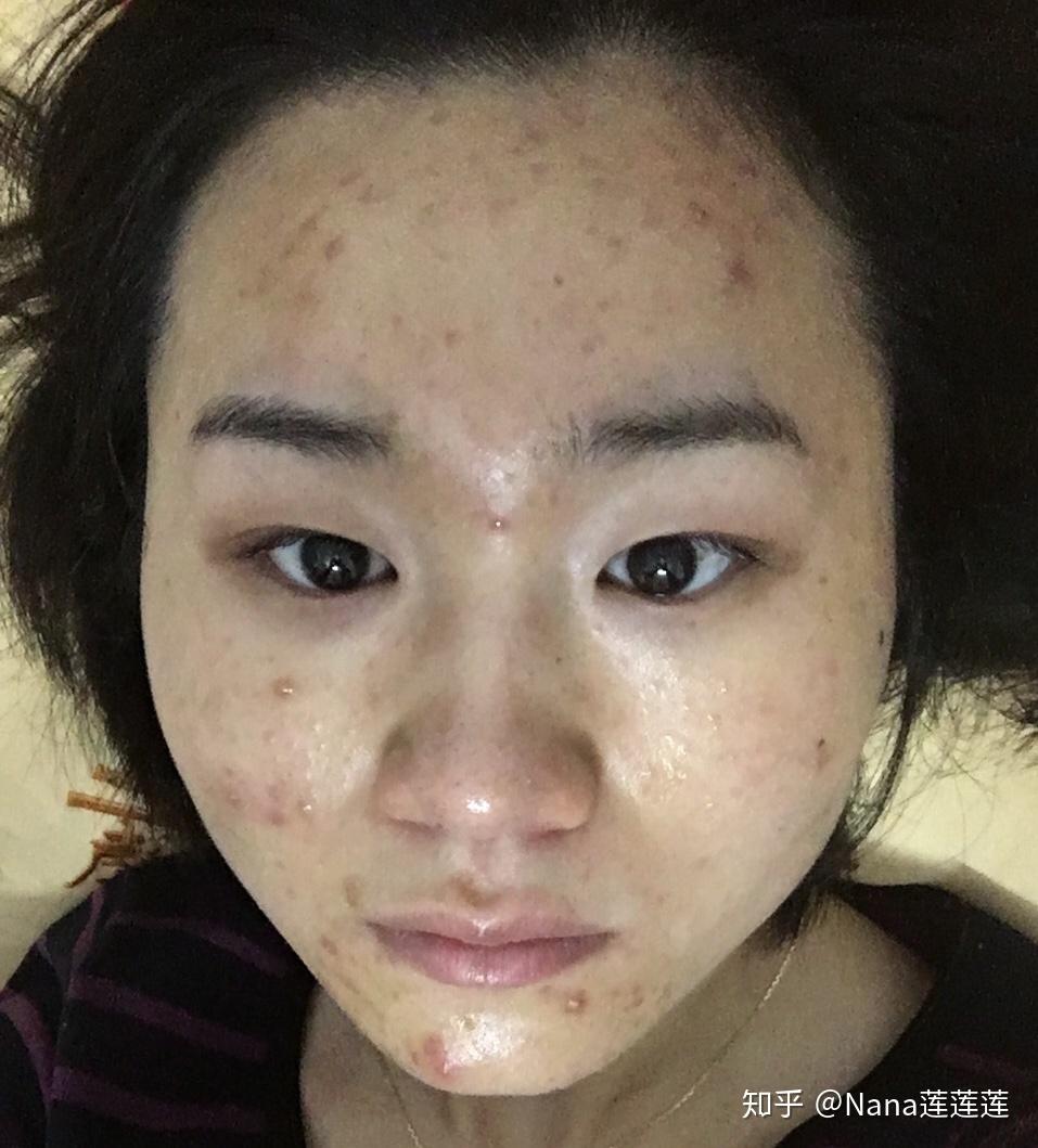 那些年,混油皮战痘烂脸走过的弯路 - 知乎