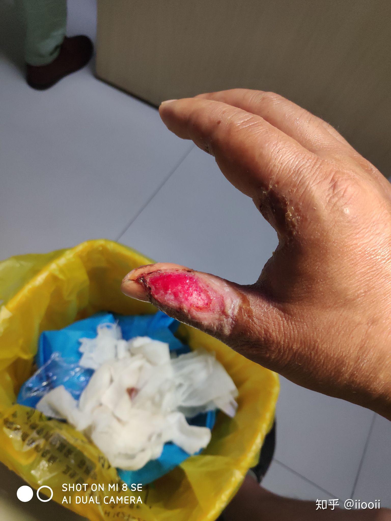 电弧烧伤疤痕增生抗疤治疗