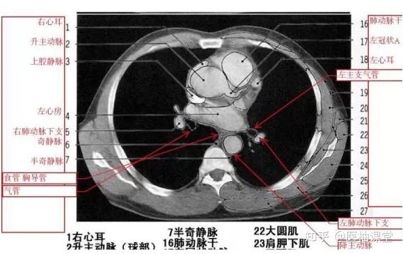 教你读懂胸部CT - 知乎