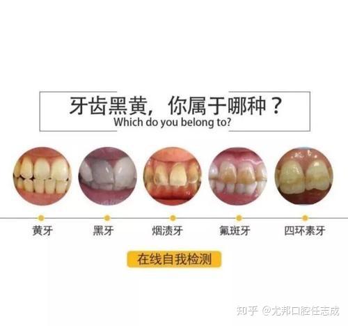 内源性着色 四环素牙