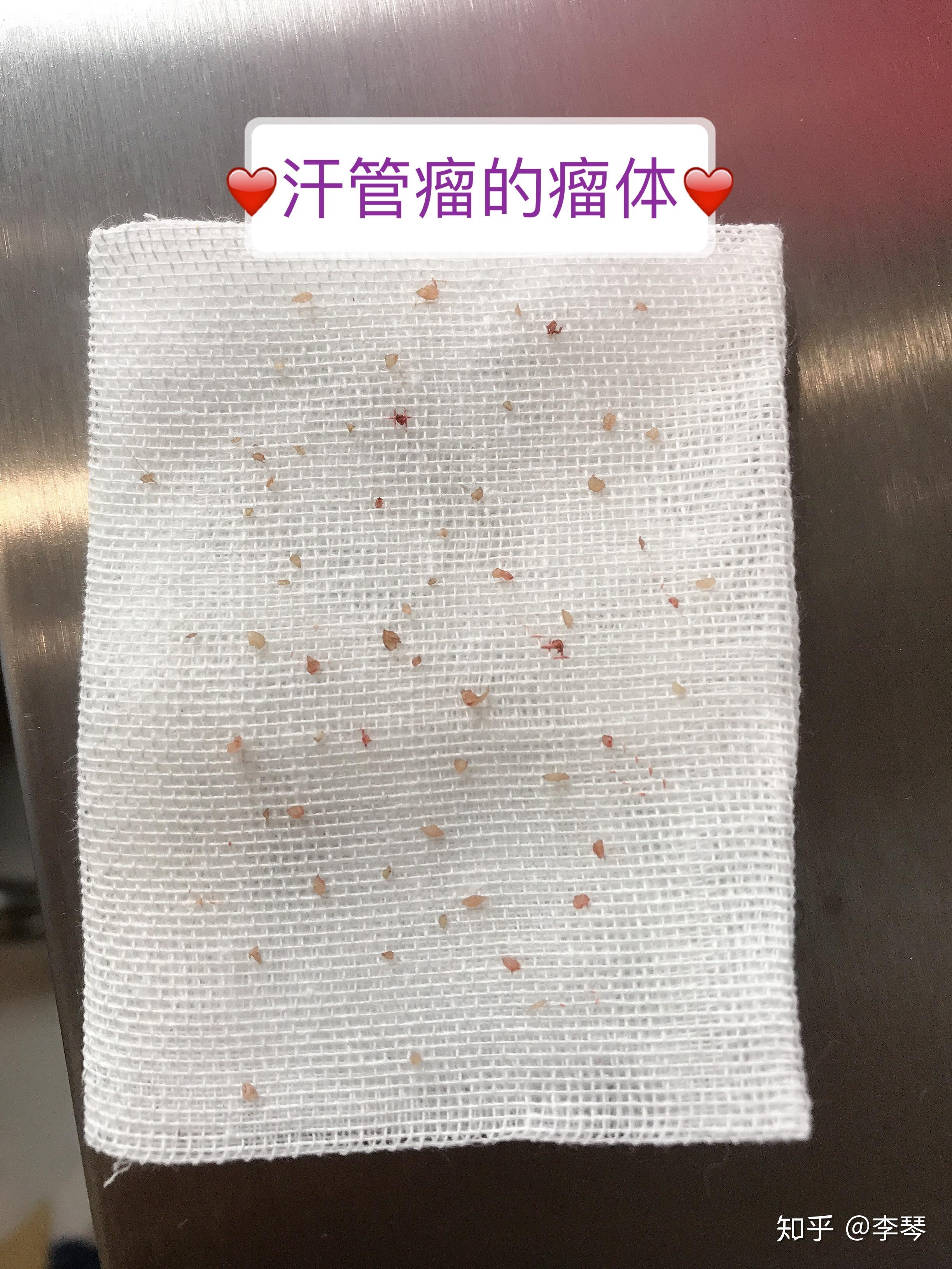 汗管瘤的纯手工提取方法