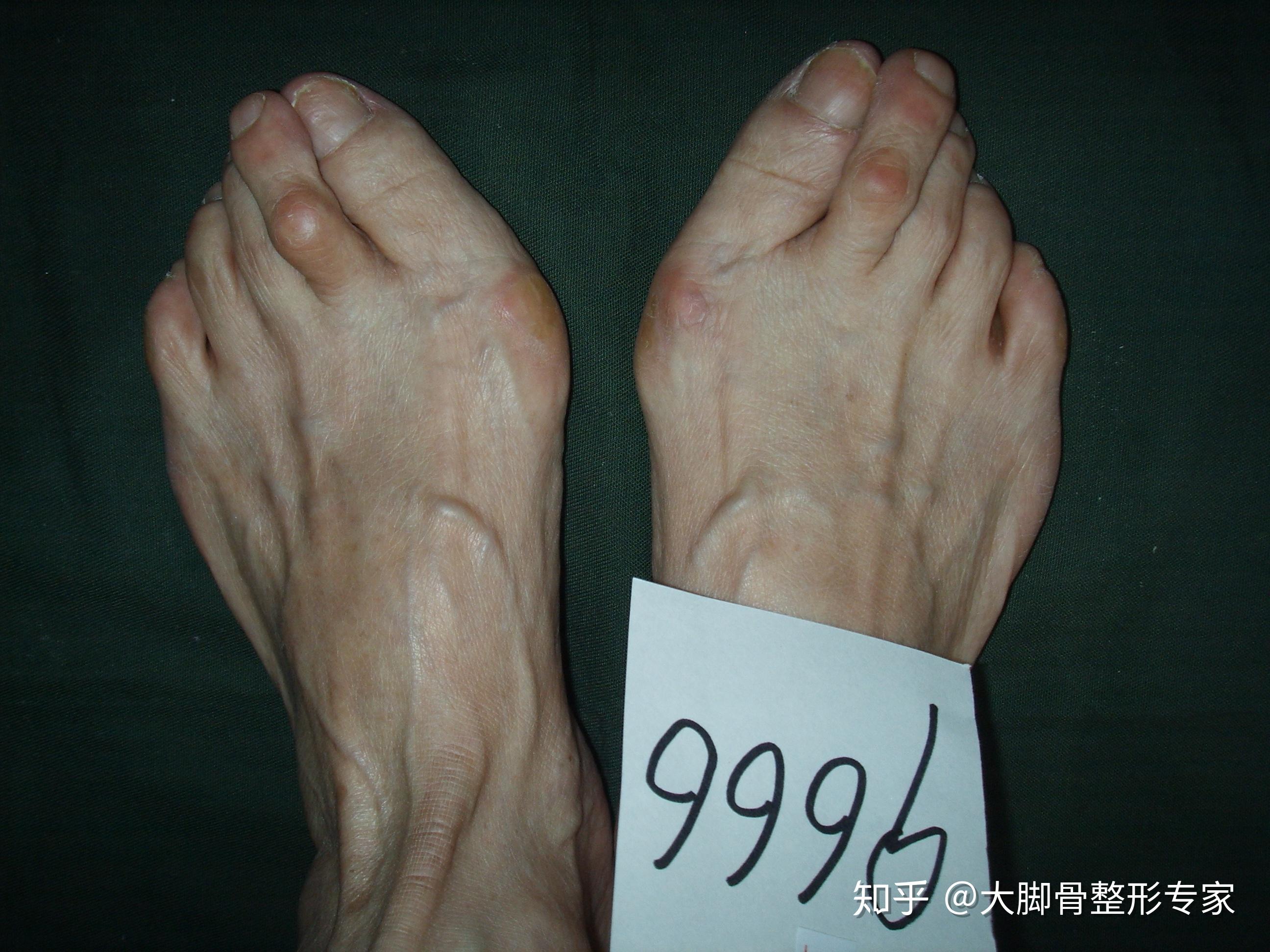 about hallux valgus-关于拇外翻大脚骨 - 知乎