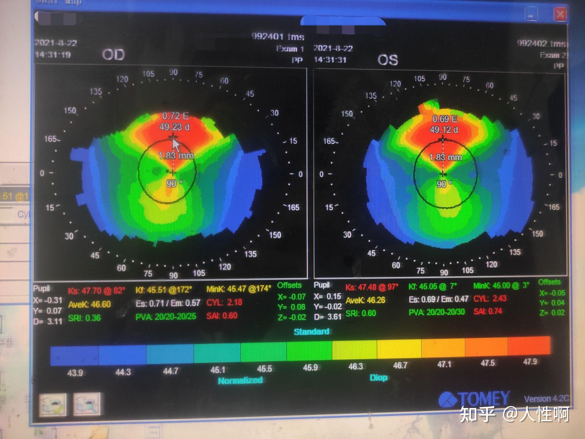 朋友们,帮我看一看这个是不是圆锥角膜的角膜地形图 