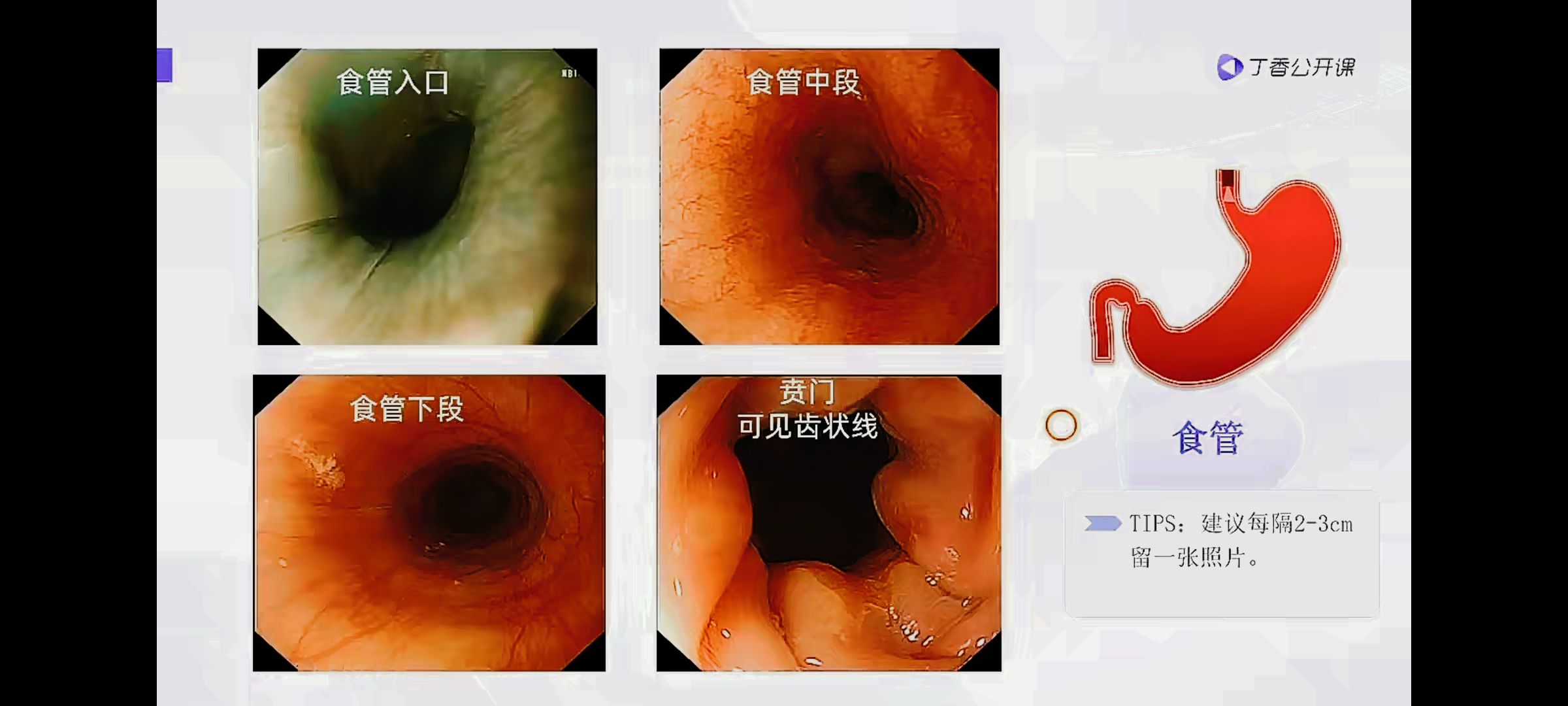 食道糜烂的胃镜图片图片