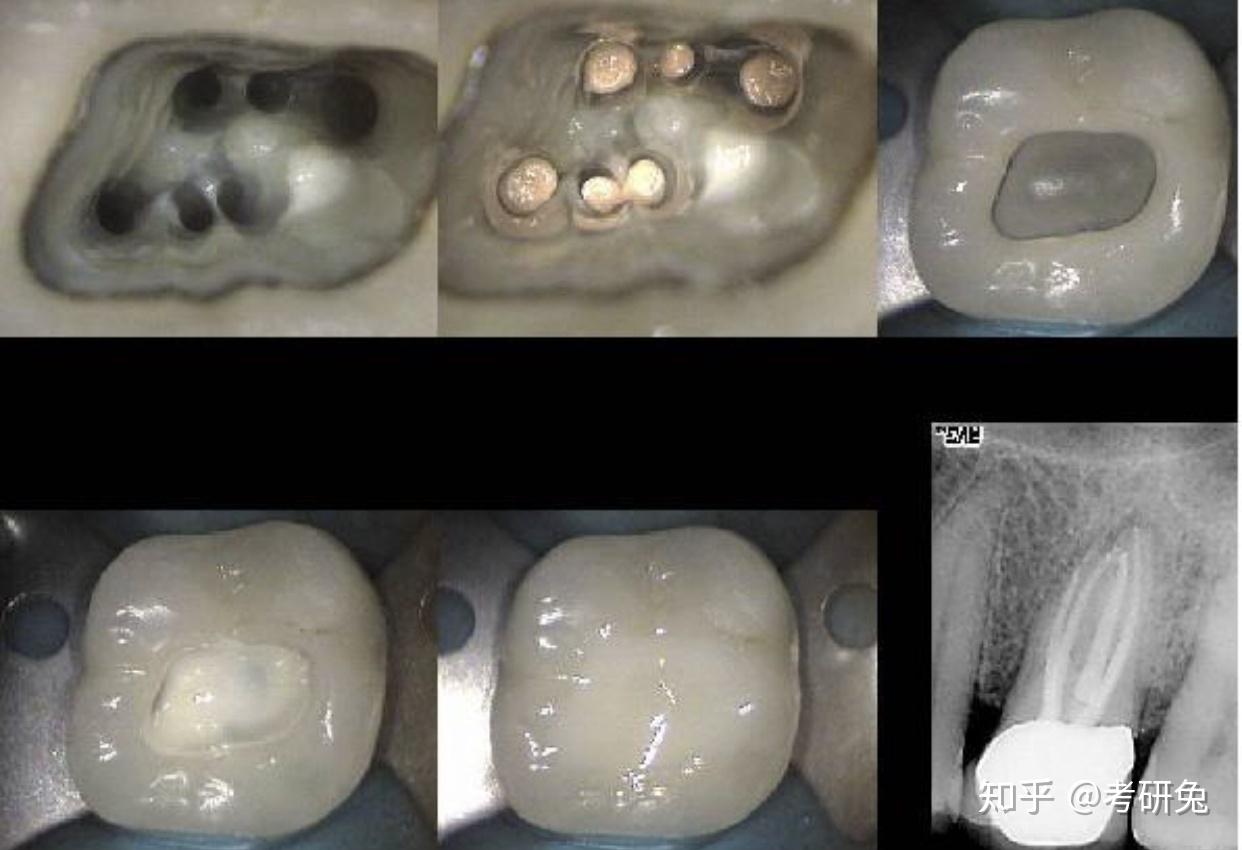 经验交流新说如何拍好口内的照片