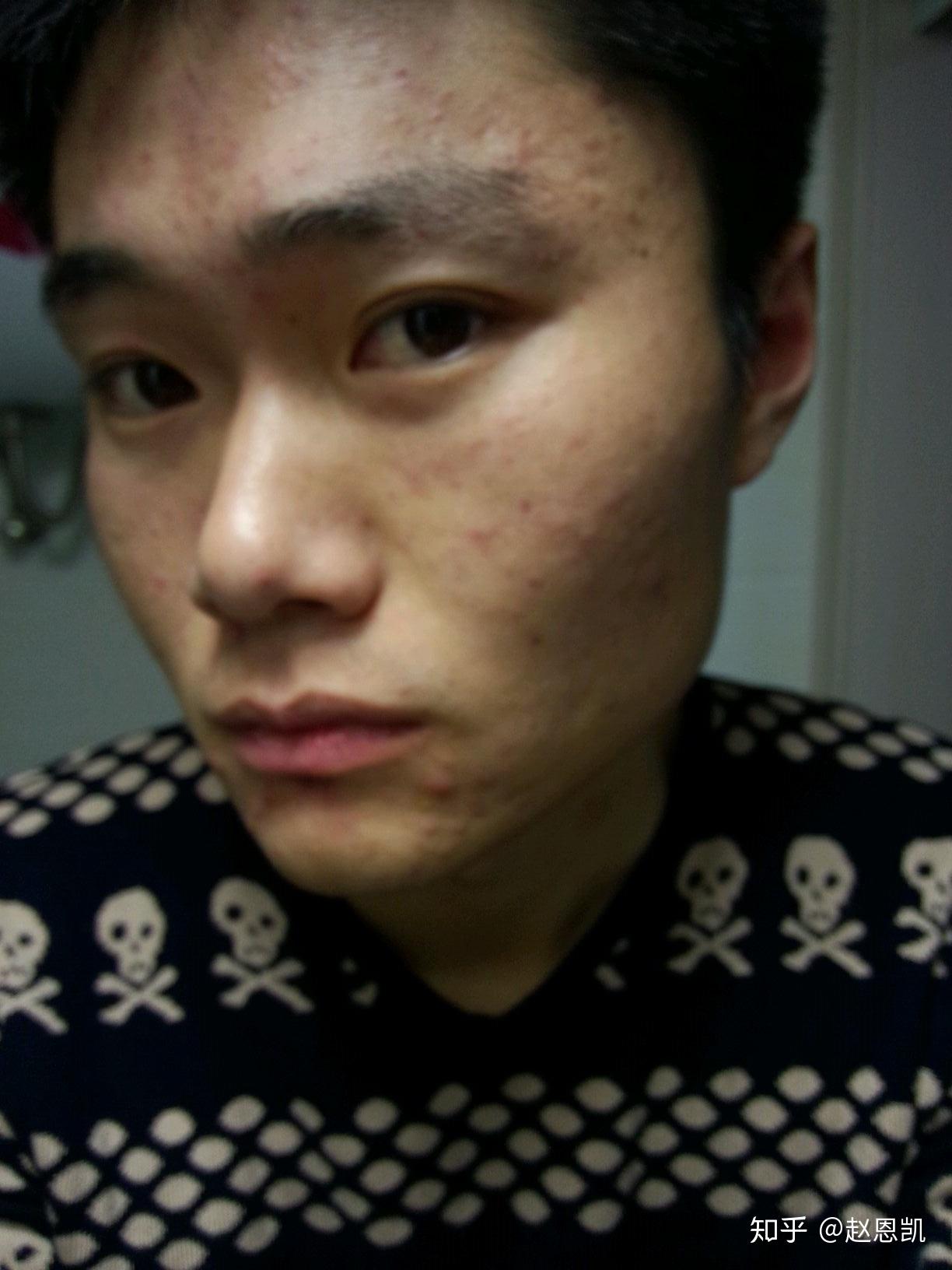 谁试过激光祛痘,价格怎么样,求试过的大神解答