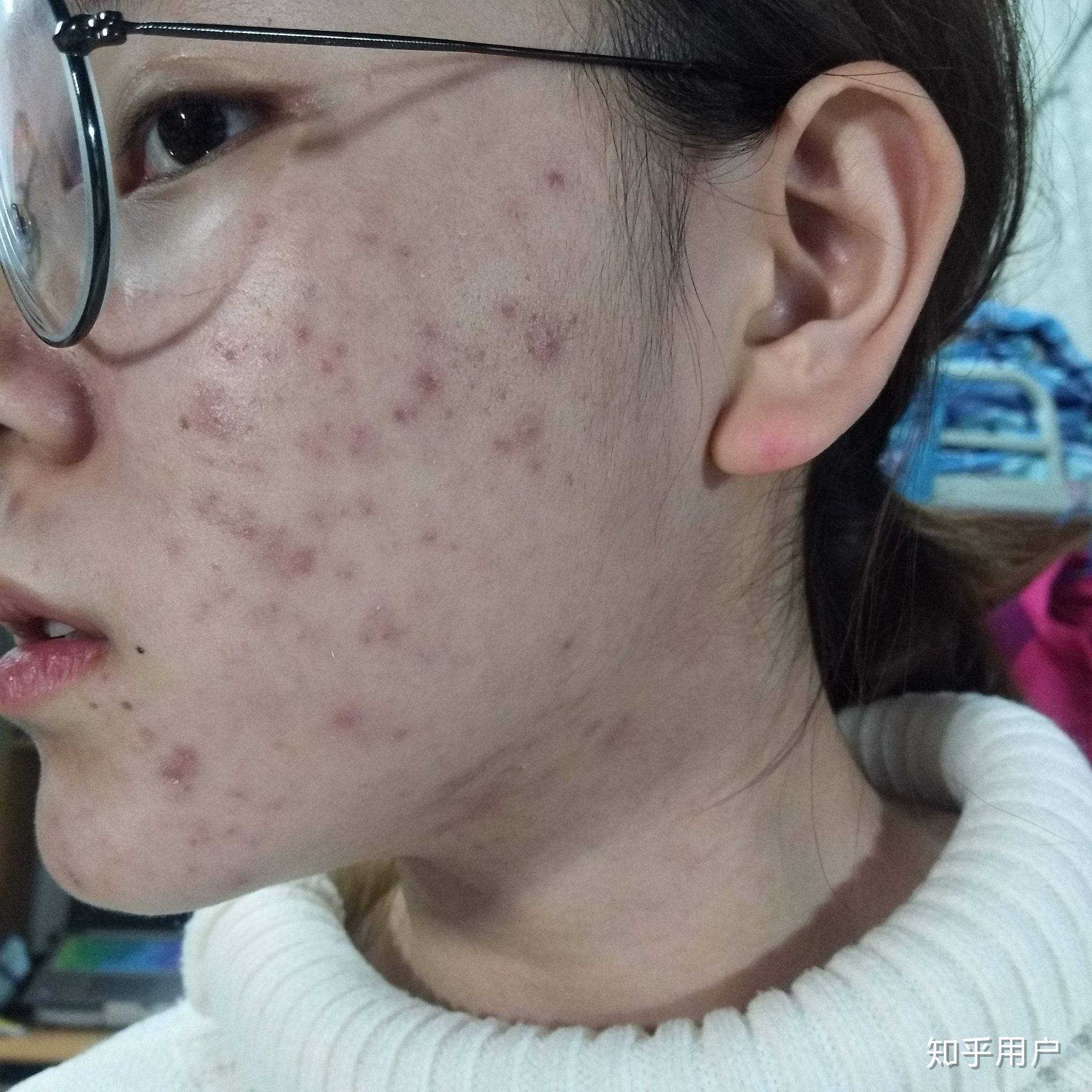 有人会喜欢长痘痘的女生嘛