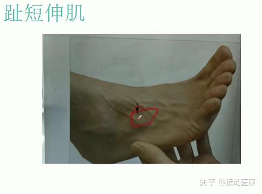 26,趾短伸肌脊柱康复,减肥,运动处方,在职大学老师主讲康复运动医硕