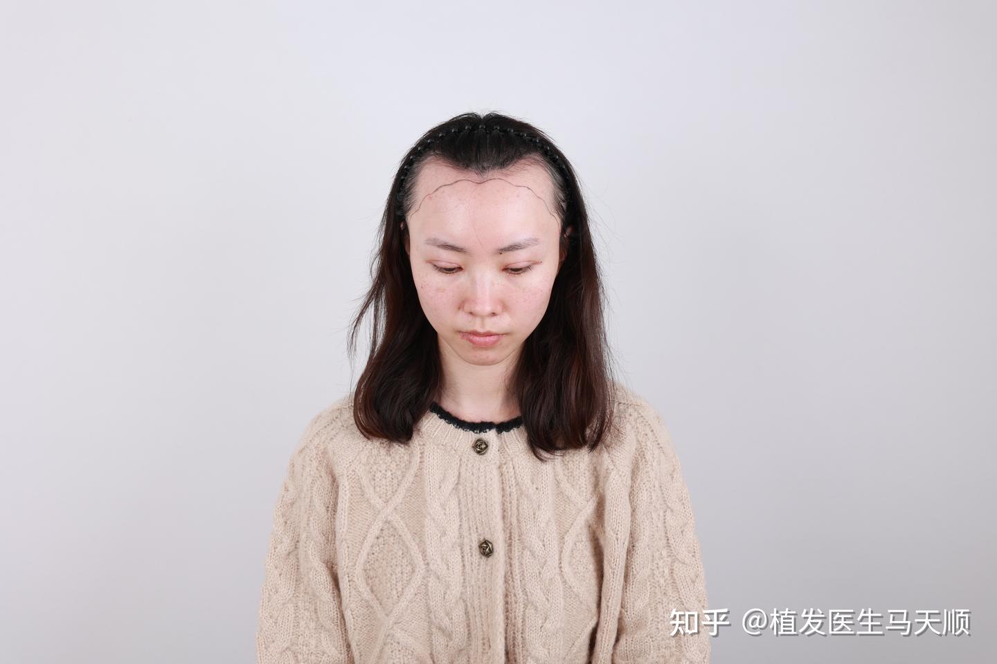 女性天生发际线比较高，脑门大，脑门凸出，可以选择植发吗？植发需要多少钱? - 知乎