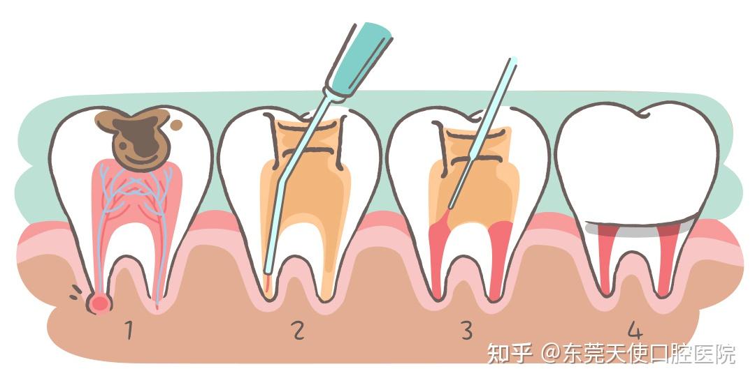 口腔科普丨烂牙里的“伪装者”--邻面龋 - 知乎