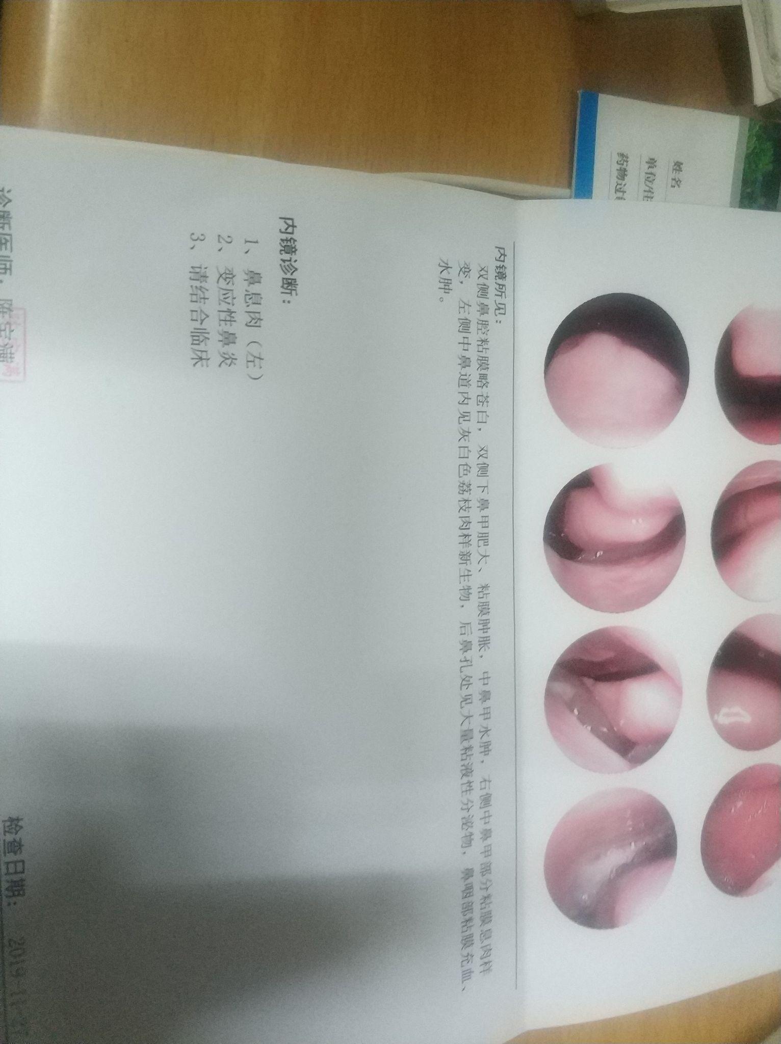 鼻窦炎鼻息肉治疗历程