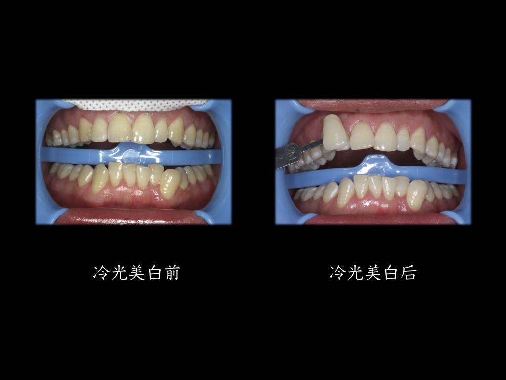 上图就是我们冷光美白前后的对比,牙色在一定程度上变白,患者也比较