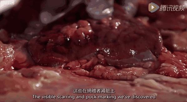 解剖脂肪纪录片图片