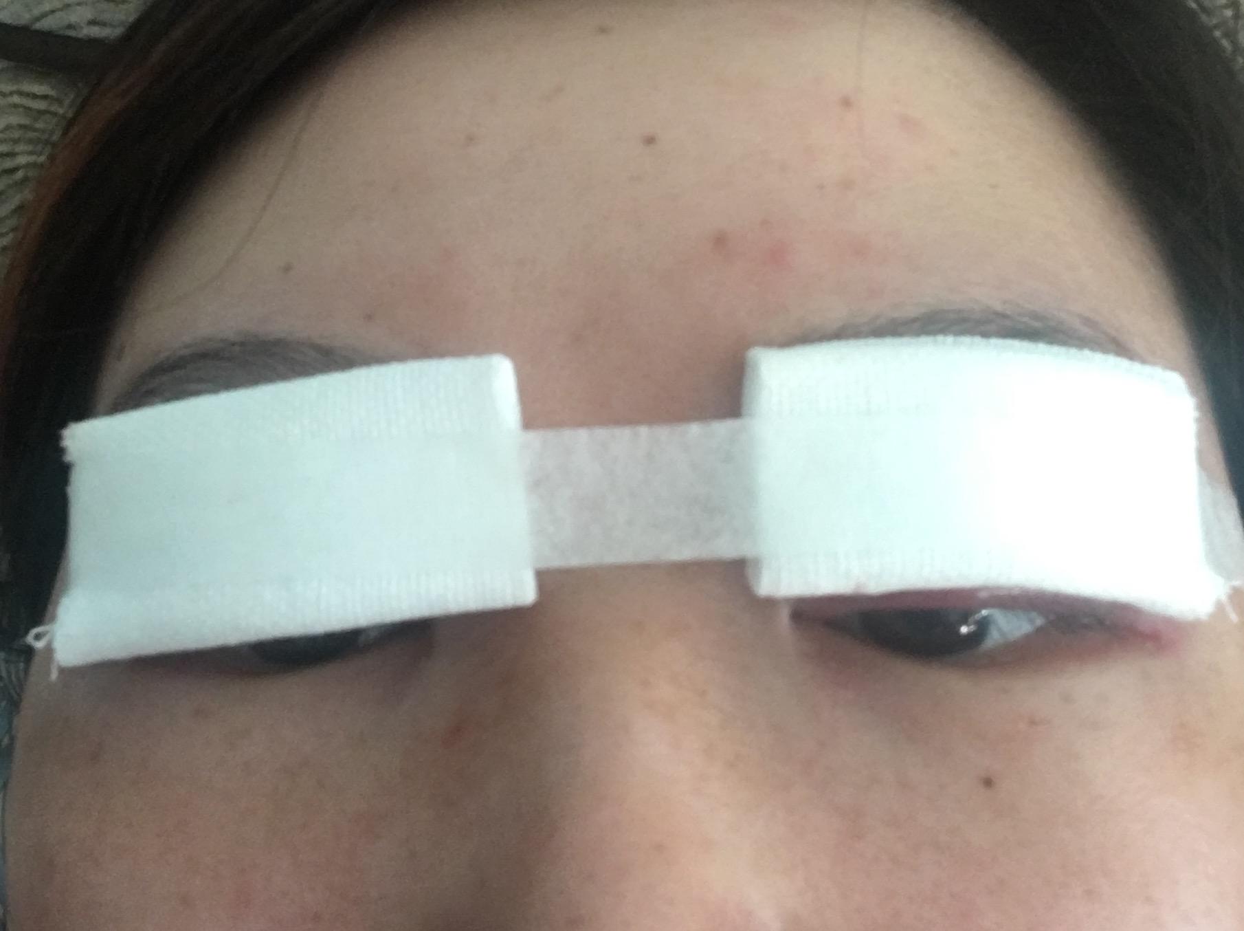 超详细的武汉割双眼皮的恢复记录案例医生分享！ - 知乎