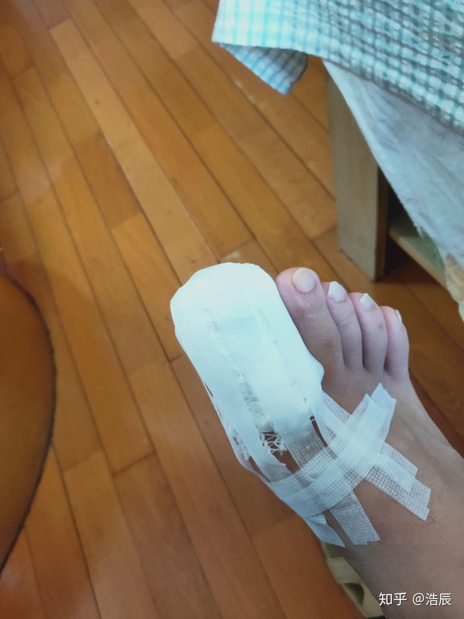 拔指甲是什么样的体验?很疼么?