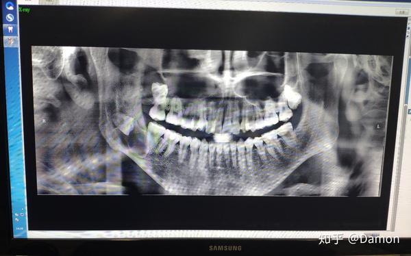 分享下颌骨囊肿 上颌窦囊肿手术经历 上颌窦囊肿手术记录 恩芝网