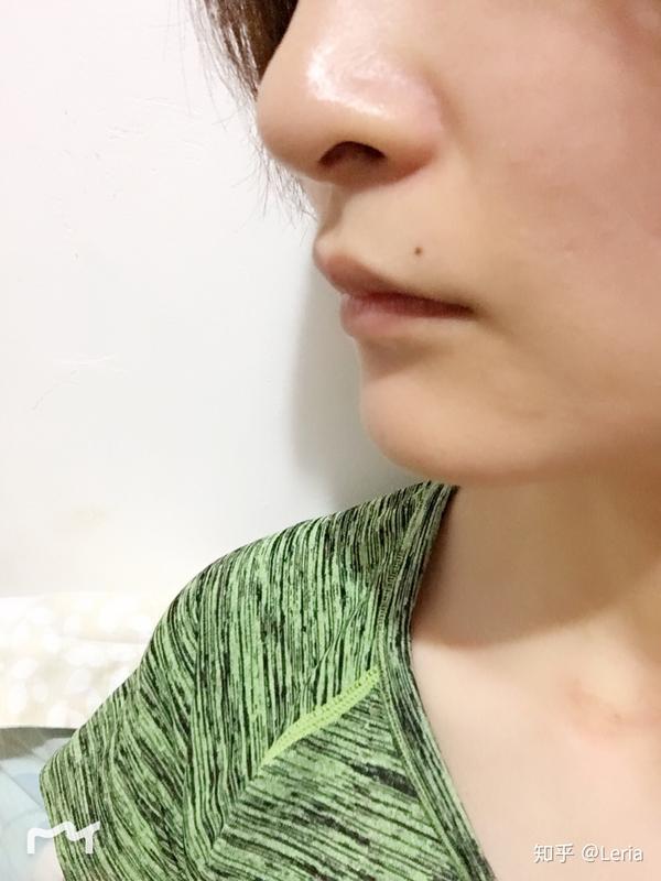 漫漫深覆合牙齿矫正之路记录