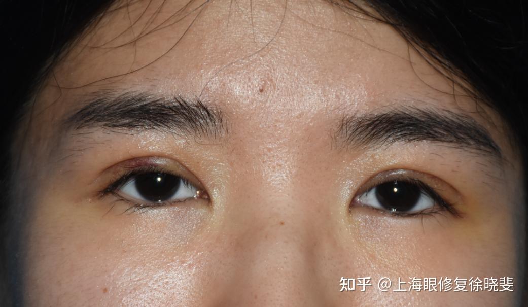 原本是双眼皮,为什么慢慢也会变成内双了? - 知乎
