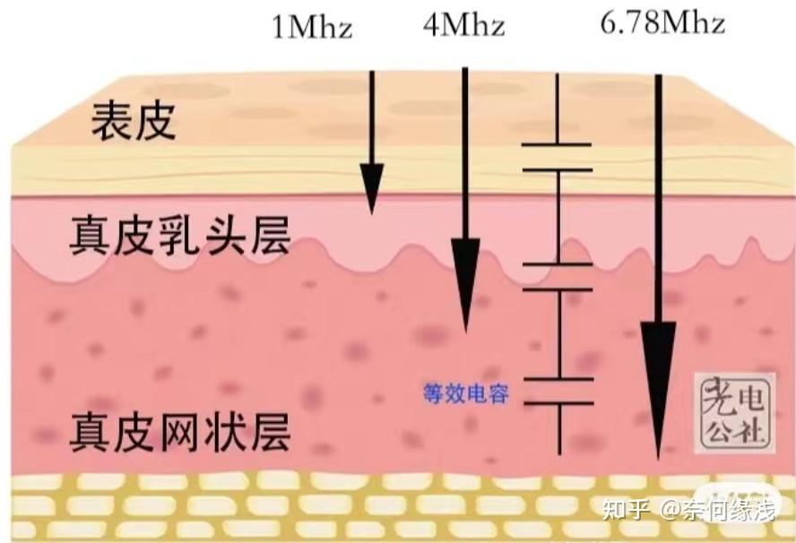 但也是最难做到的,决定着射频能量是作用到表皮,真皮乳头层还是胶原