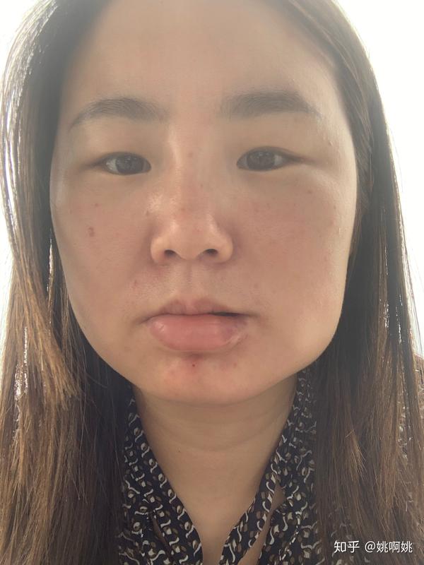 上海九院成人血管瘤治疗过程
