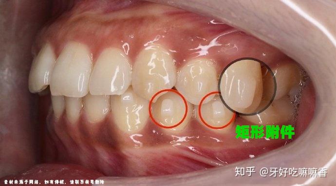 隐形矫正粘贴附件有什么好处