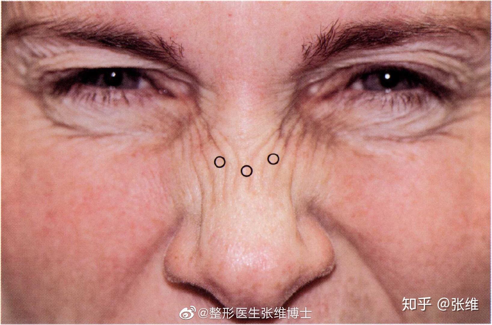 Botox Cosmetic(onabotulinumtoxinA，A型肉毒毒素注射剂)中文说明书-价格-功效与作用-副作用-香港济民药业