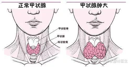 你知道吗 甲状腺乳头状癌是温和 善良的 知乎