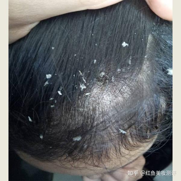 为什么儿童头发总是油腻头皮屑多？如何解决？?清透头皮保护 - 知乎