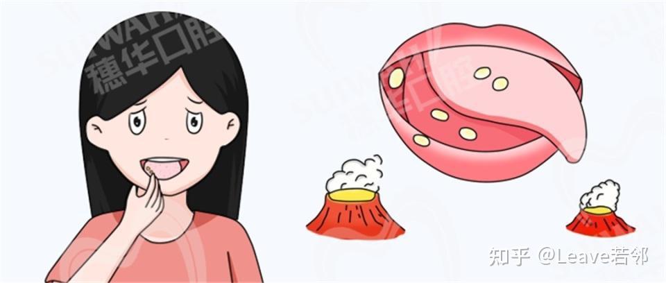 长了口腔溃疡千万别掉以轻心！这3种口腔溃疡建议及时就医！ - 知乎