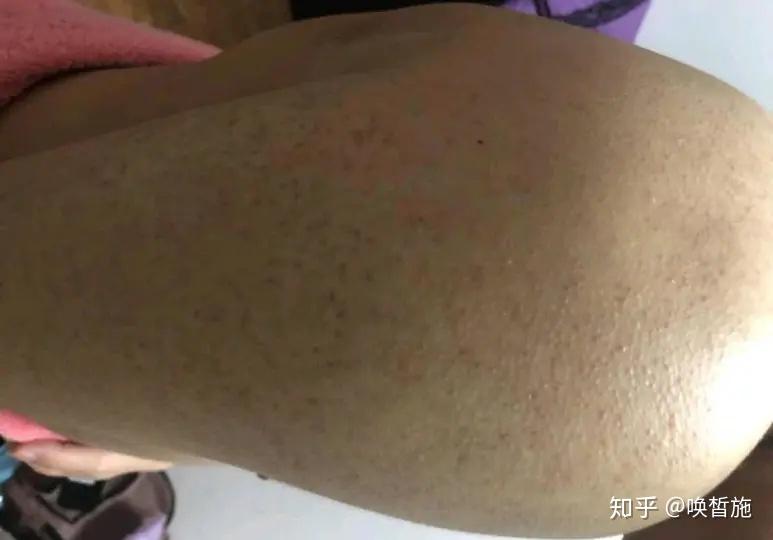 治疗鸡皮肤的有哪些医生(治疗鸡皮肤的有哪些医生呢)