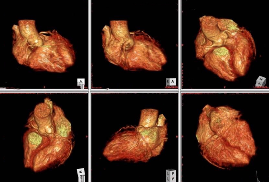 三维图像综上,利用磁共振成像技术可以在一定程度上实现对心脏冠脉的
