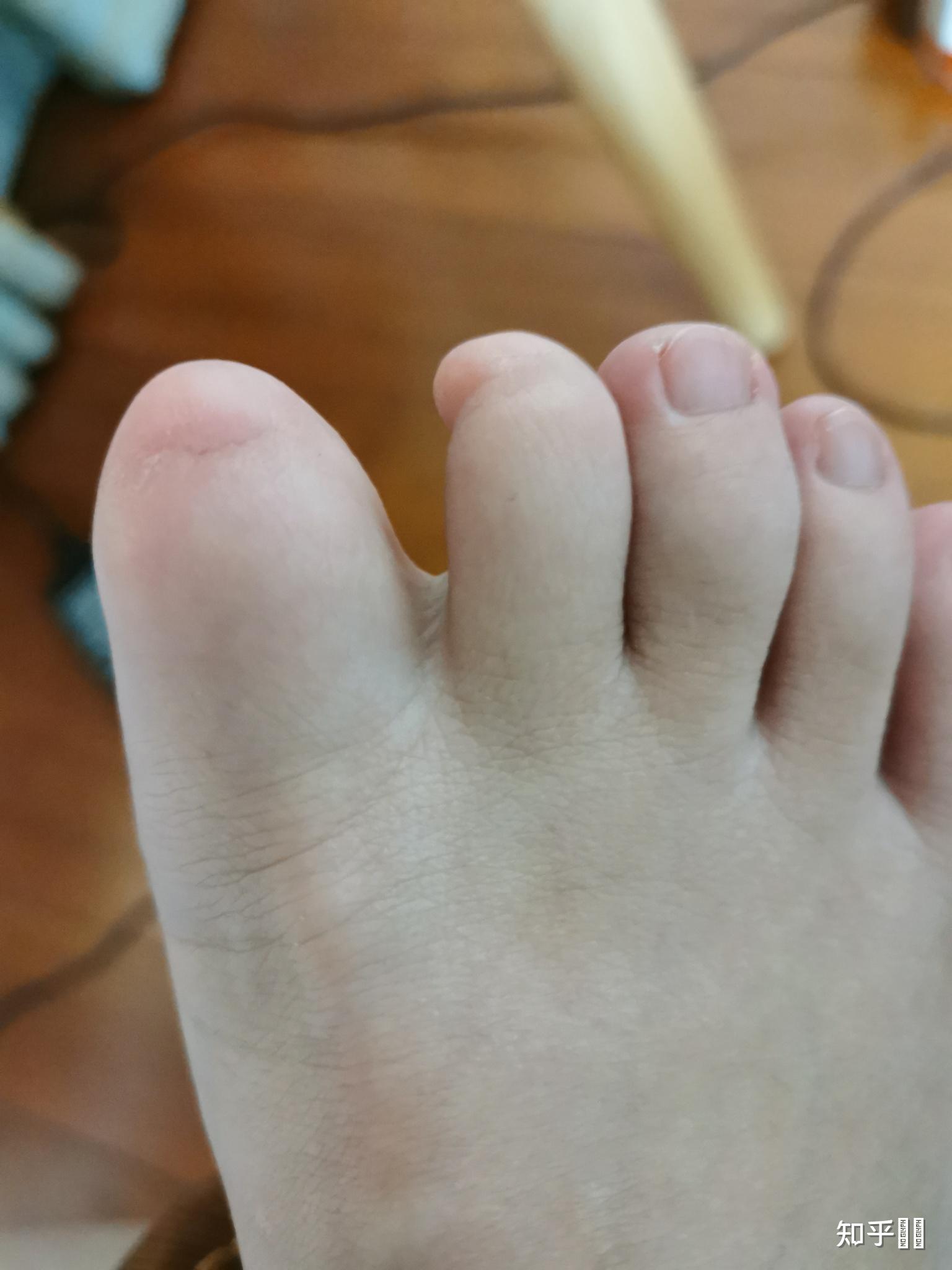 人类如果没有脚指甲会怎样