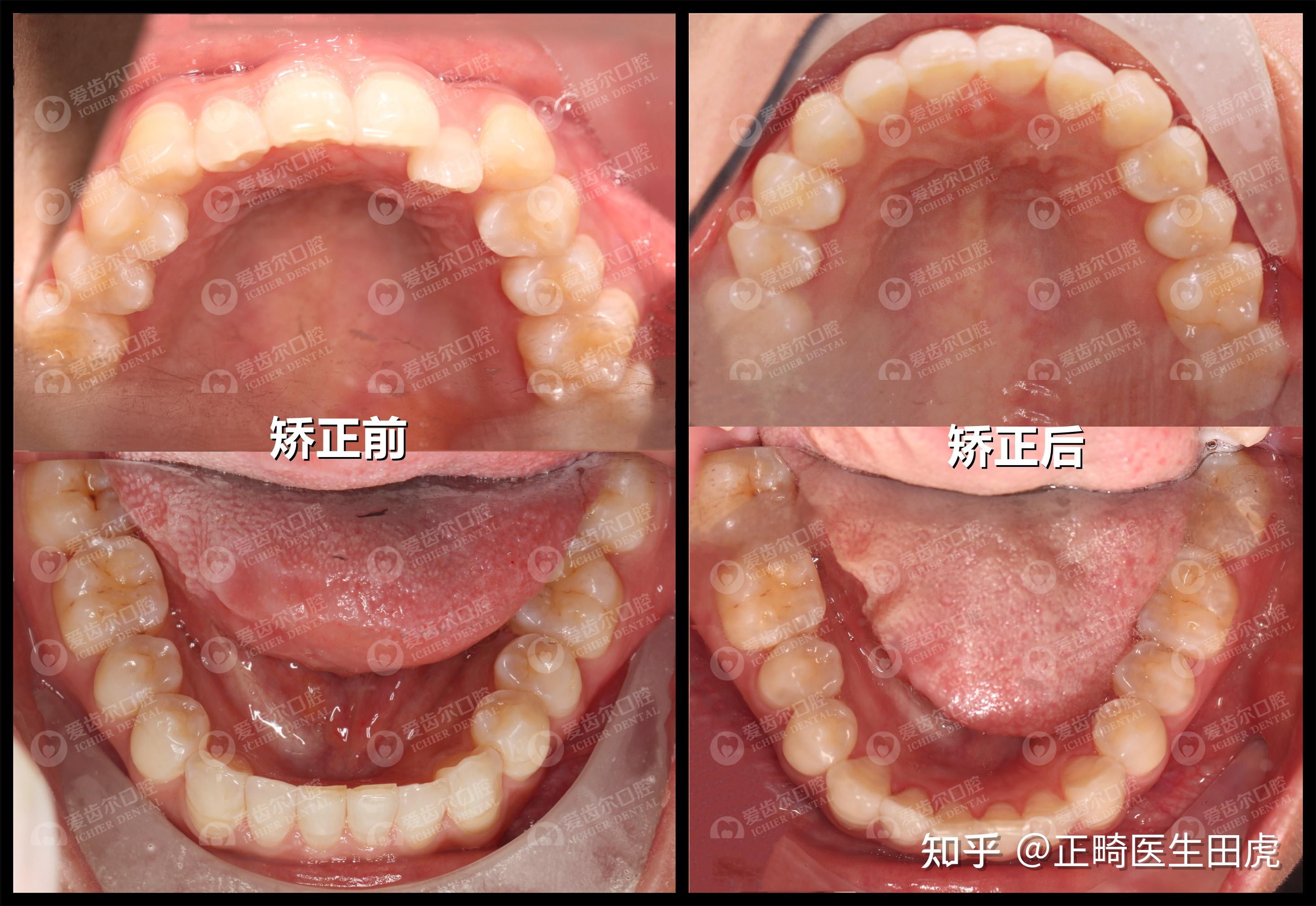 隐适美矫正骨性地包天改变自己从此开始