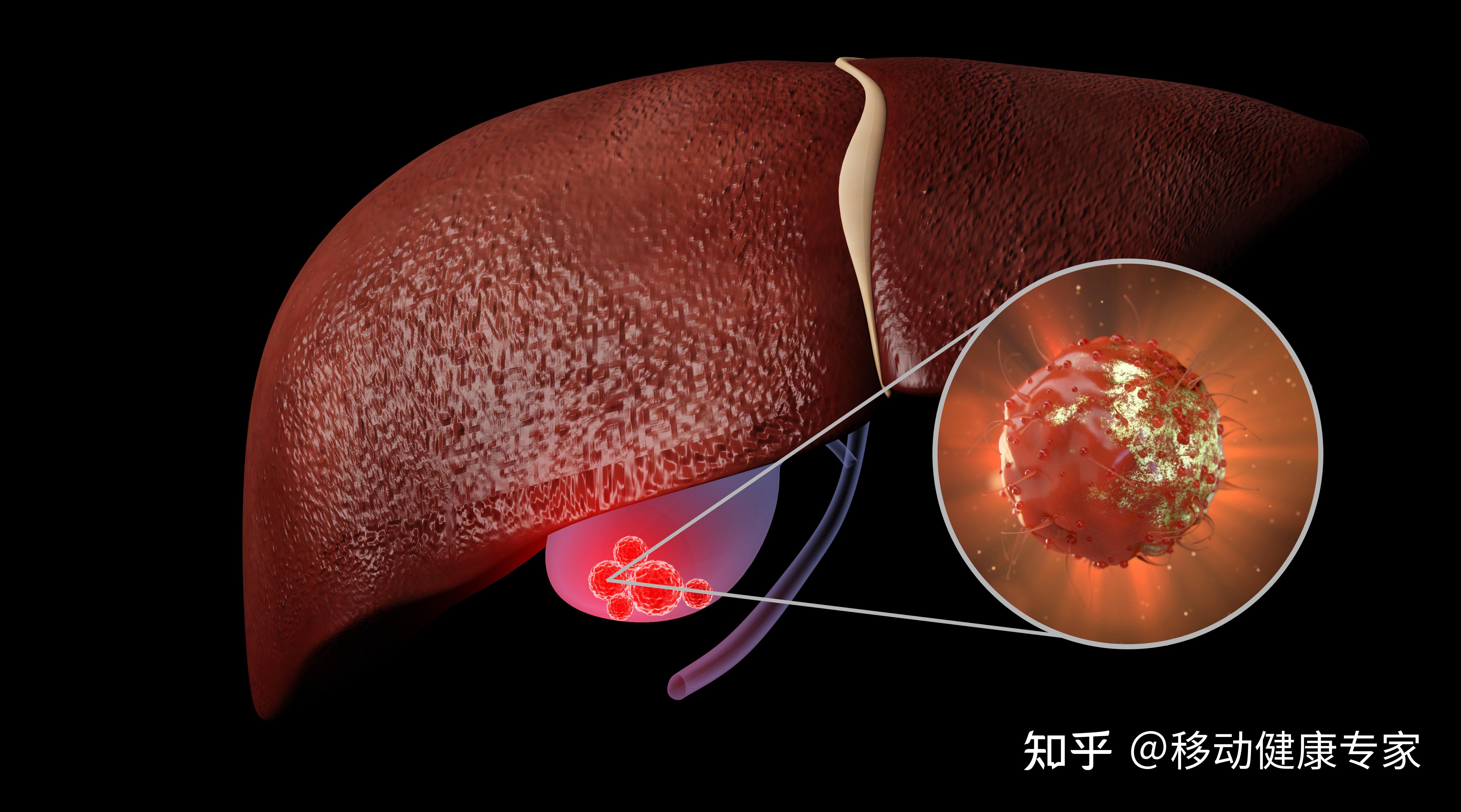 如病毒性肝炎抗病毒治療,酒精性肝硬化戒酒等.