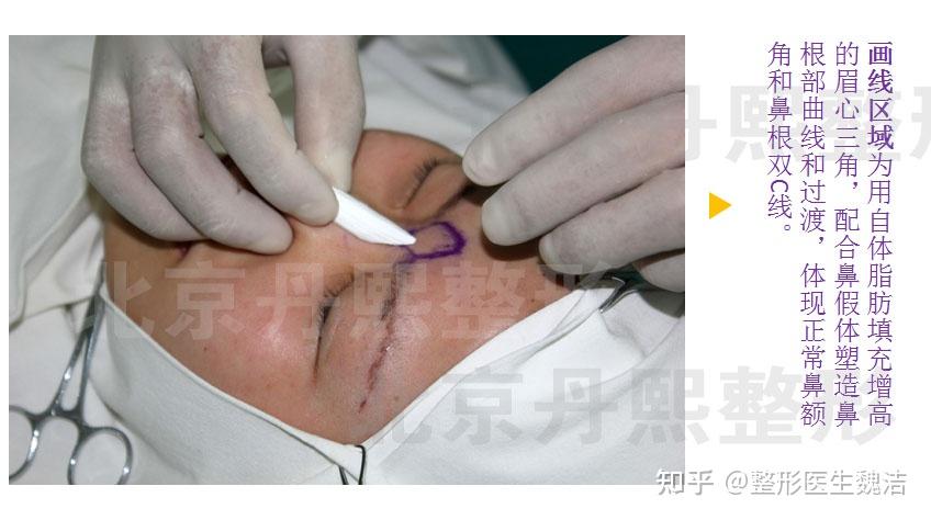 眉心三角区域低平,垫眉弓或鼻整形时假体可以直通眉心么? - 知乎