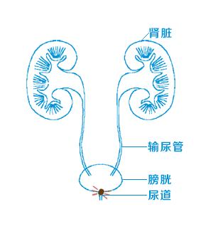 1,肾结石较小时,可随尿液在输尿管内活动,经过输尿管狭窄处时与输尿管