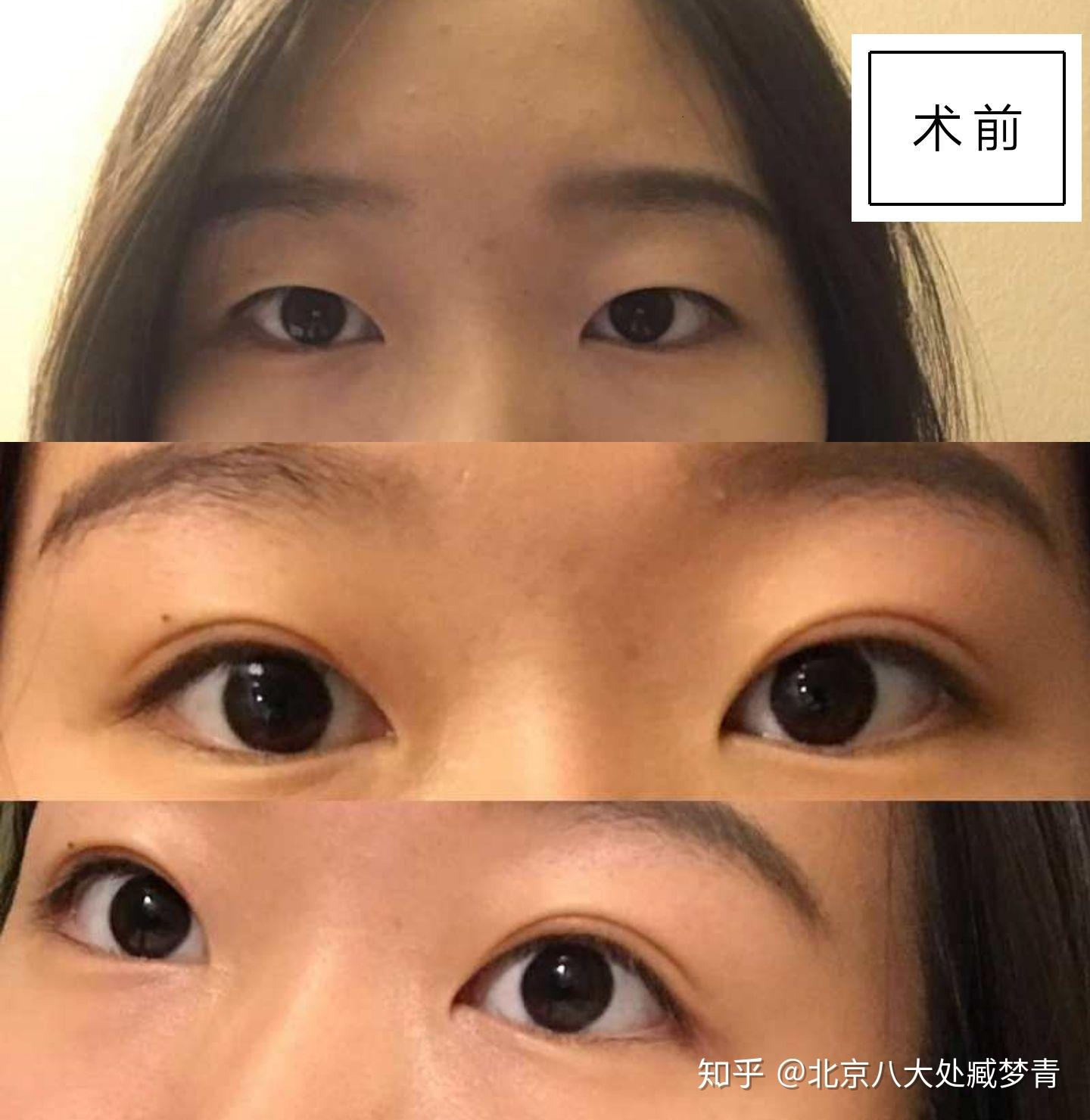双眼皮都分为哪几种形状？