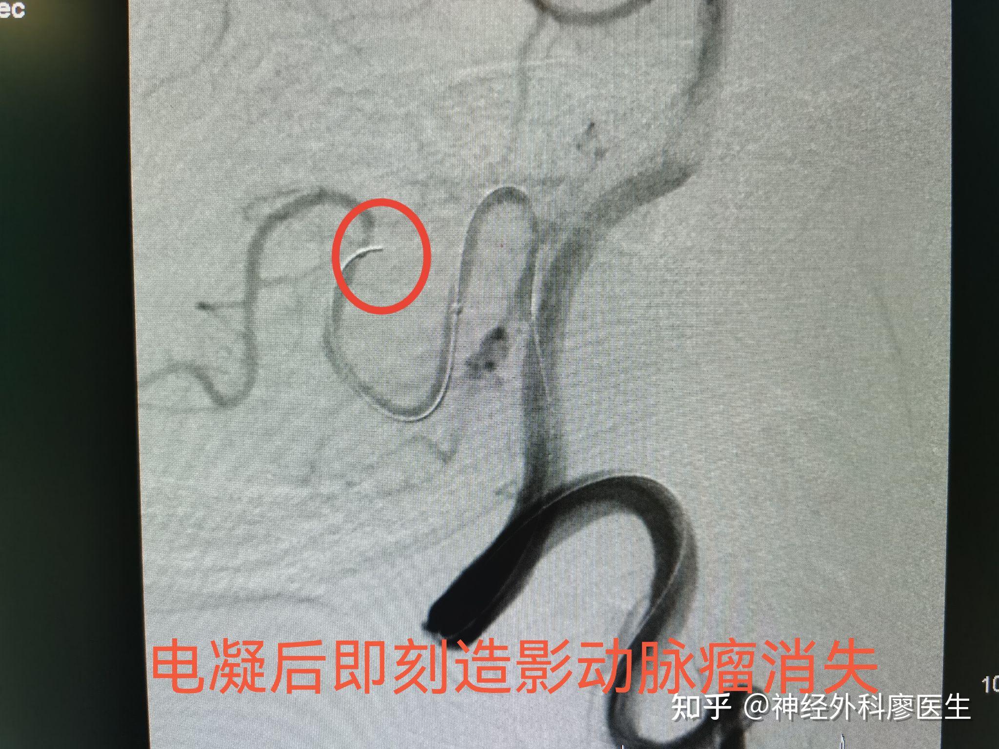 微小动脉瘤特殊治疗 - 知乎