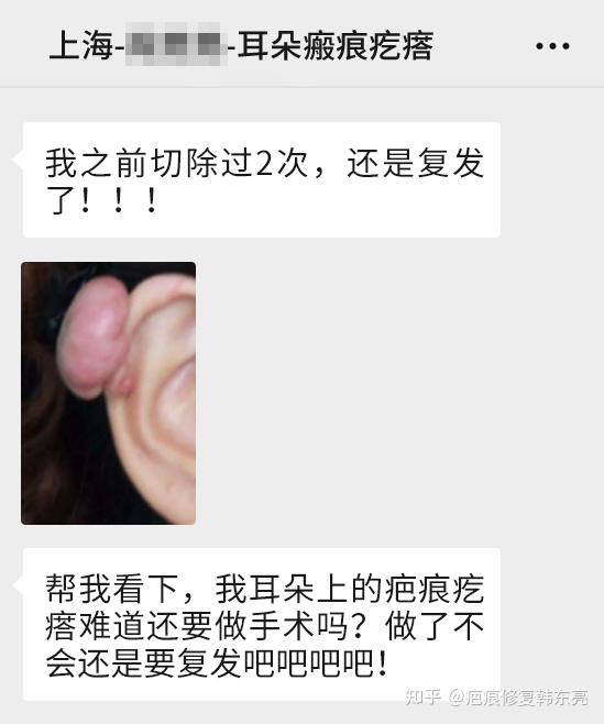 瘢痕疙瘩复发