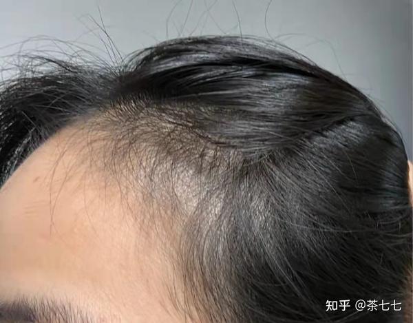 发量增多加头发养护小经验!!! - 知乎