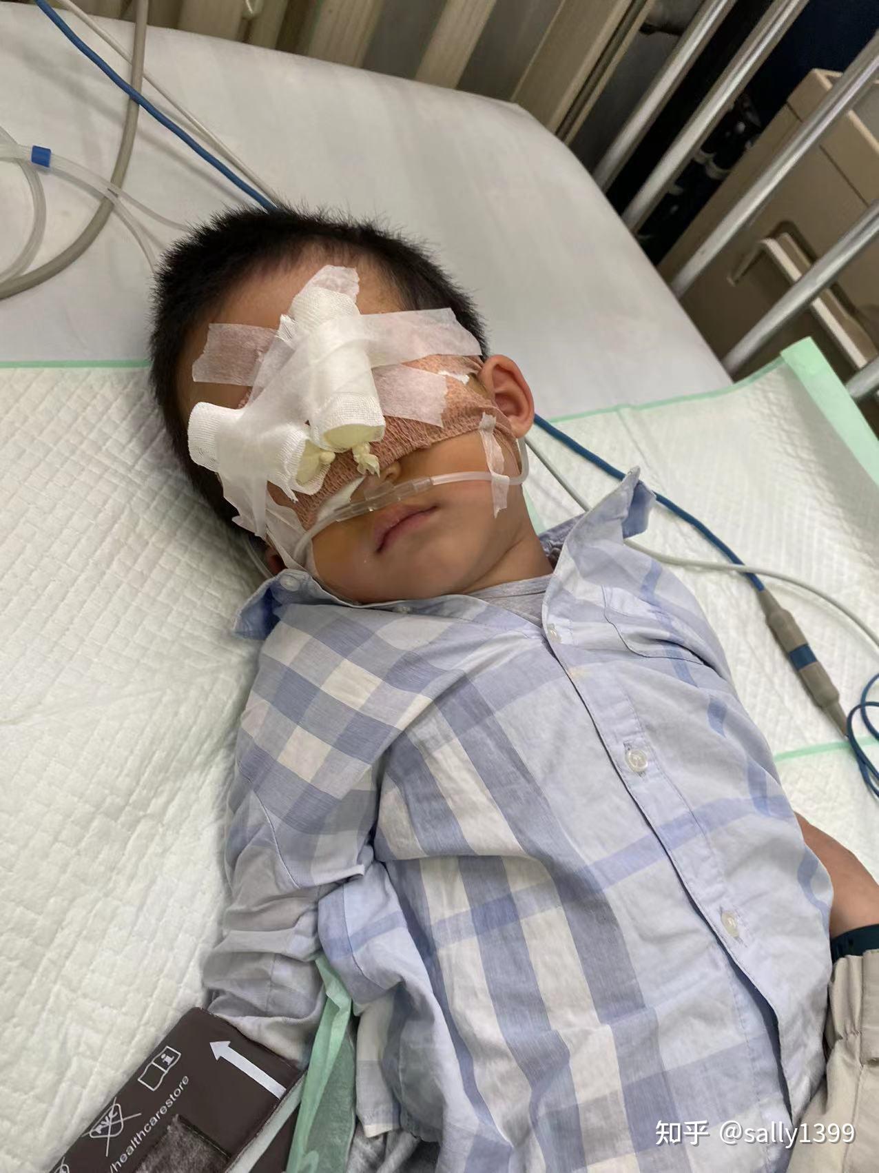 北京儿童医院倒睫手术