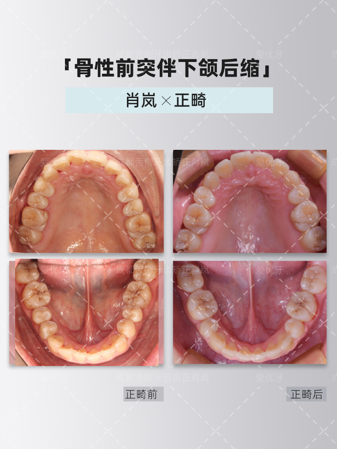 下颌舌隆突的位置图片图片