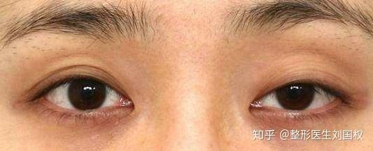 双眼皮手术失败常见的表现形式及对应的修复方式 知乎