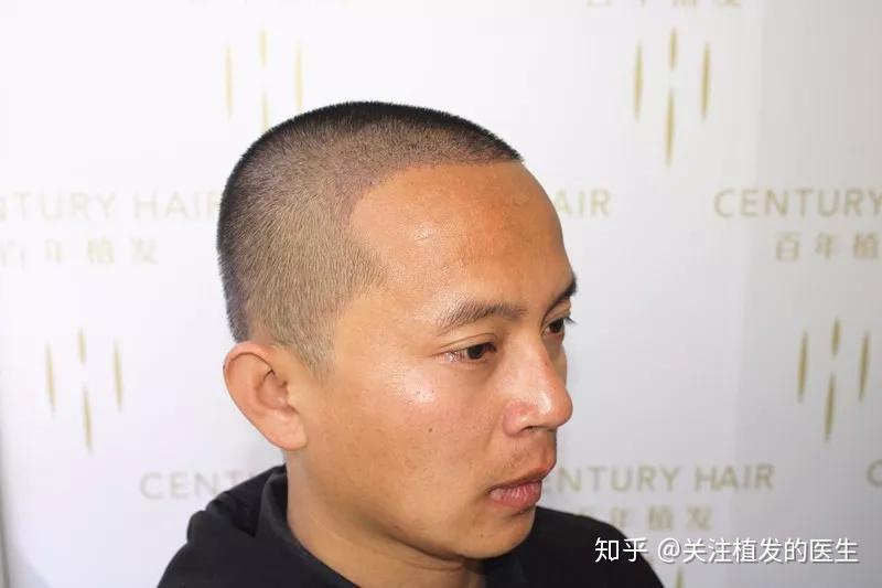 无锡植发微针种植2000毛囊单位焕发青春好颜值